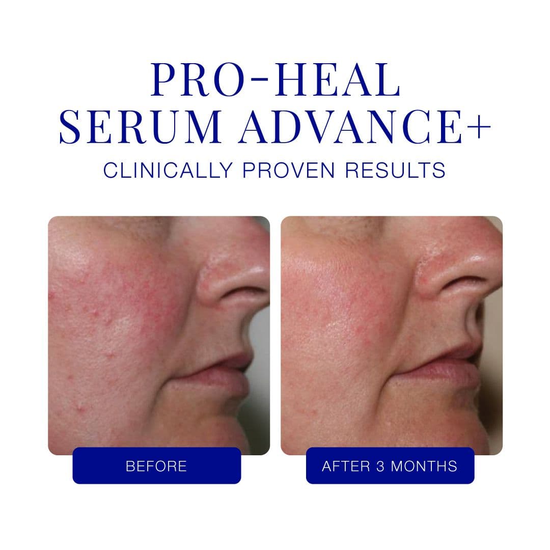 Vom Hersteller bereitgestellter Vorher-Nachher-Vergleich zu Pro-Heal Serum Advance+ nach drei Monaten