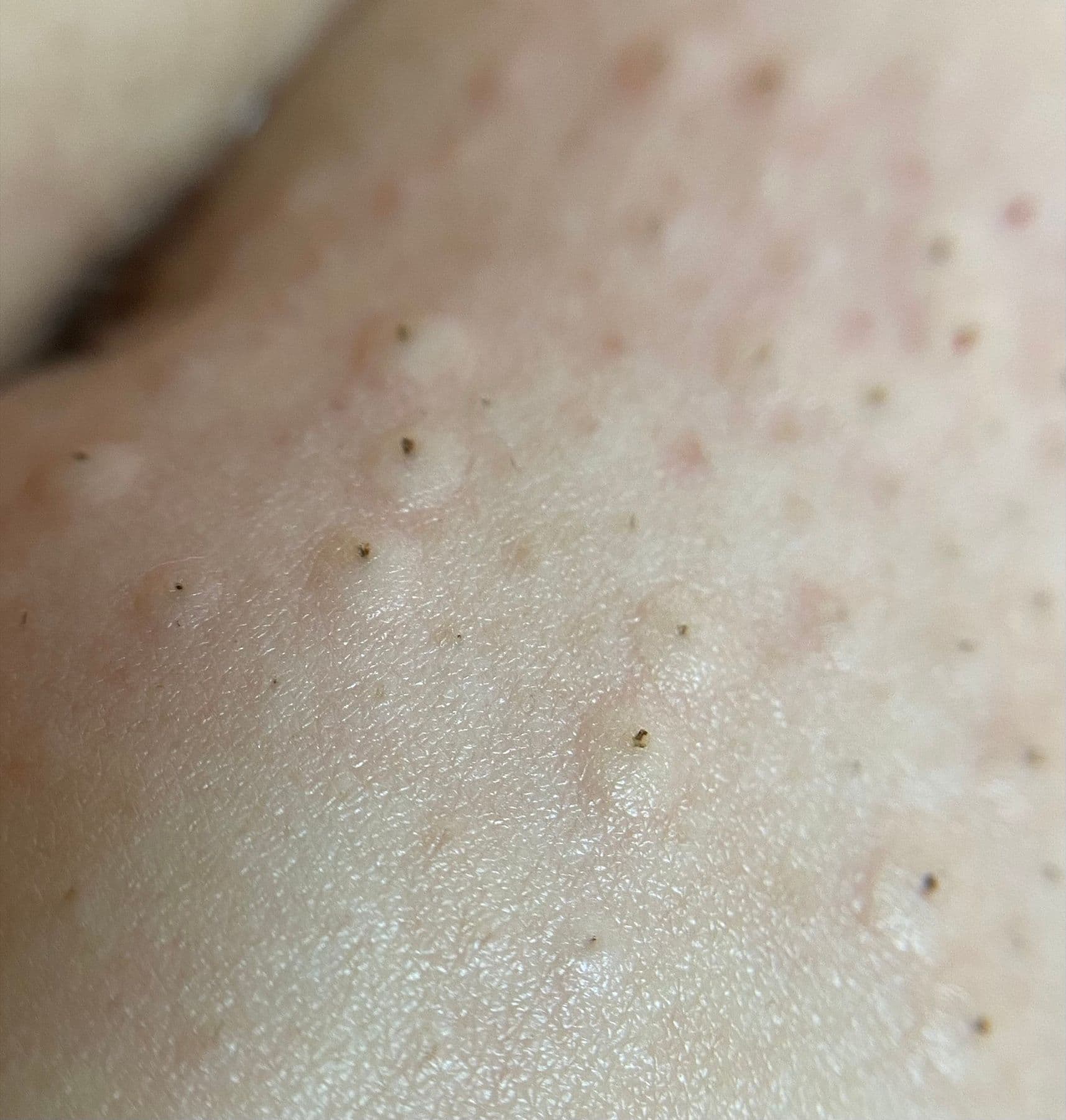 Nahaufnahme einer möglichen unmittelbaren Haut- und Haarreaktion nach einer Laserbehandlung
