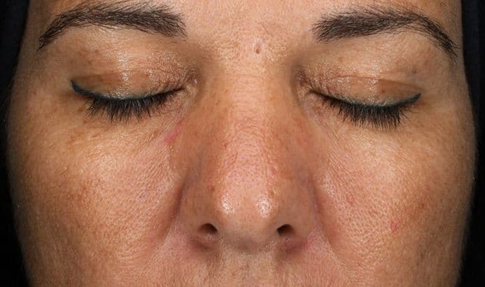 Hautbild vor dem Microneedling – frontale Ansicht