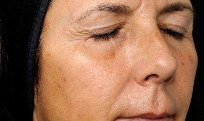 Hautbild vor dem Microneedling – seitliche Ansicht